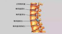 腰间盘突出可以做俯卧撑锻炼吗？