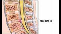 腰突可以练瑜伽吗？